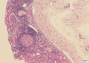 (A) Part of the Renal biopsy showing global glomerulosclerosis, an intact viable glomerulus and an epithelioid granuloma H&E, 40x