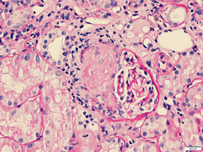 (B) A glomerulus showing segmental sclerosis, Periodic acid-Schiff 20x