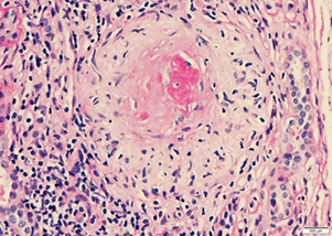 Non-necrotizing epithelioid granuloma centered on remnants of glomeruli,  Periodic acid-Schiff 40X and Methenamine Silver 40X