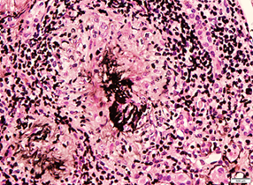 Non-necrotizing epithelioid granuloma centered on remnants of glomeruli,  Periodic acid-Schiff 40X and Methenamine Silver 40X